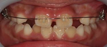 歯を磨いている

低い精度で自動的に生成された説明