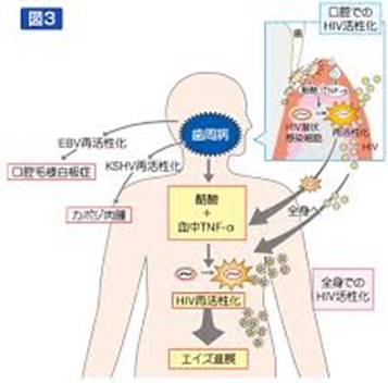 「歯周病菌 全身」の画像検索結果