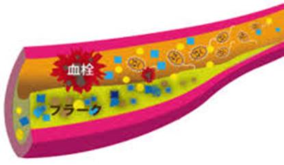 「歯周病菌 全身」の画像検索結果